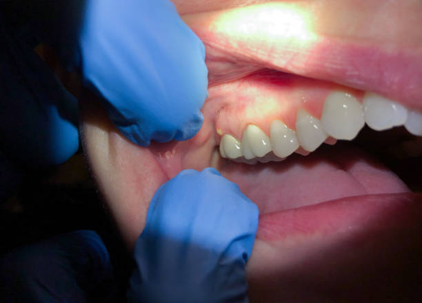 Best Emergency Treatment for Dental Infections or Abscesses in Meridian, TX